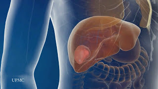 CT interpretation  liver hemangioma [upl. by Towny]