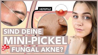 Pickel auf der Stirn – Das hilft bei FUNGAL AKNE [upl. by Idolah618]