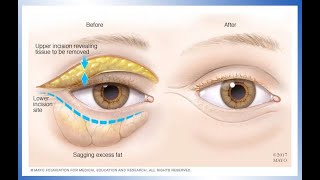 How to Tighten Skin Around Eyes  Reduce Wrinkles [upl. by Prager]