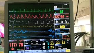 Adenosine induced transient cardiac arrest [upl. by Idnerb]