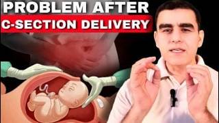 Problems After Cesarean  डिलीवरी के बाद होने वाली प्रॉब्लम्स  C Section Complications [upl. by Olaf824]