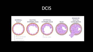 Breast Cancer Review Series DCIS and IDC [upl. by Ojimmas]