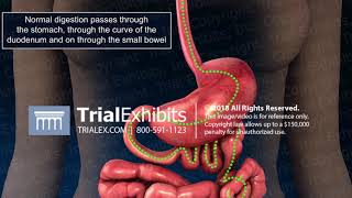 Paralytic ileus  Medical Definition and Pronunciation [upl. by Koser]