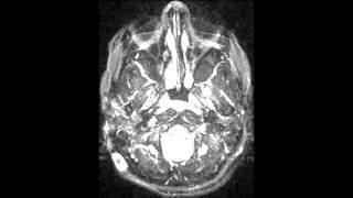 Intracranial Hypotension [upl. by Chick]