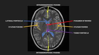 Introduction to MRI of the brain [upl. by Deborath]