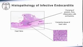 Endocarditis Pathophysiology [upl. by Katherin]