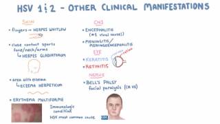 HSV  Clinical Presentation  Part 2 [upl. by Lesli]