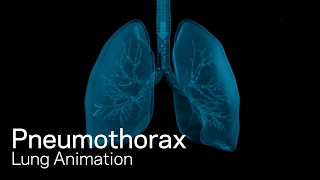 Pneumothorax [upl. by Senn]