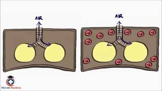 Pneumothorax and Tension Pneumothorax [upl. by Eiramesor114]