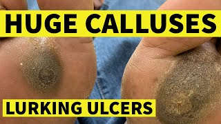 Huge Calluses Lurking Ulcers [upl. by Colvin]