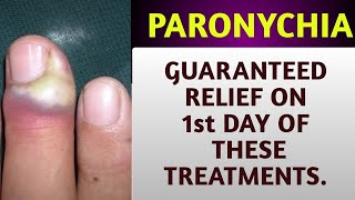 Paronychia Home remedies  Finger nail infection  skin infections  Onychomycosis Treatment [upl. by Nancey]