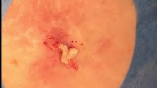 Cyst Explodes Just Missing Camera Doctor Works Hard to Extract it All [upl. by Arquit492]