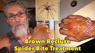 Brown Recluse Spider Bite Treatment Part 1  Dr Robert Cassar [upl. by Cummine]