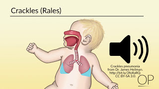 Paediatrics  Signs of respiratory distress [upl. by Anirtik258]