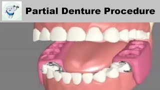 Removable Partial Dentures Steps [upl. by Nevile]