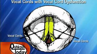 Vocal Cord Dysfunction [upl. by Ninetta]