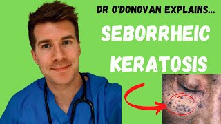 Explaining Seborrheic Keratosis  With Dr ODonovan [upl. by Adabelle]