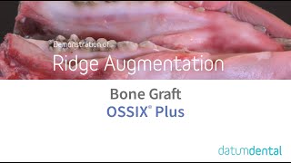 Ridge Augmentation  OSSIX® Plus amp bone graft [upl. by Annuhsal]