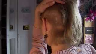 Trichotillomania Why These Women Rip Out Their Own Hair [upl. by Rovert995]