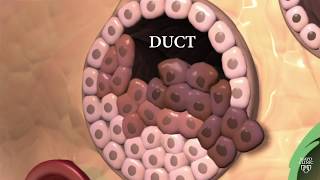 Surgeon simply explains breast ductal carcinoma insitu DCIS [upl. by Fital]