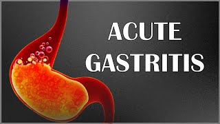 What causes erosive gastritis  Health Channel Best Answers [upl. by Issiah]