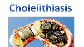 Cholelithiasis [upl. by Gerge]