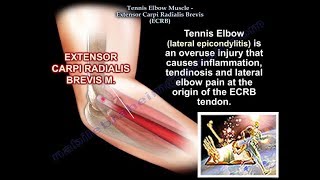 Tennis Elbow Extensor Carpi Radialis Brevis Everything You Need To Know  Dr Nabil Ebraheim [upl. by Amieva]