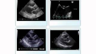 Native Valve Endocarditis [upl. by Hasen]