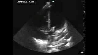 Aortic and Mitral Valve Endocarditis [upl. by Schou]