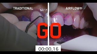 Abrasive teeth cleaning method vs AIRFLOW method [upl. by Titos133]