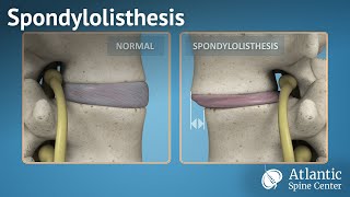 Spondylolisthesis [upl. by Aemat]