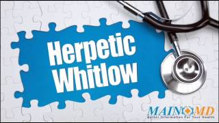 Herpetic Whitlow ¦ Treatment and Symptoms [upl. by Terrab]