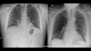 Hemothorax pneumothorax pleural effusion [upl. by Mireielle]