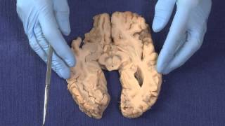 Basal Ganglia Neuroanatomy Video Lab  Brain Dissections [upl. by Nibram899]