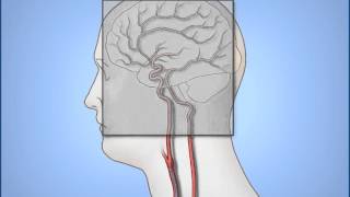 FİBROID EMBOLIZATION PAIN FREE [upl. by Karlis194]