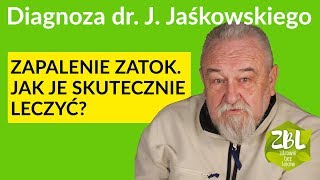 dr Jerzy Jaśkowski  Leczenie zapalenia zatok [upl. by Baer]