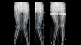 How Does a Prosthetic Knee Work [upl. by Paton304]