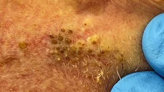 Extremely Clogged Pores Extracted  Contour Dermatology [upl. by Mungovan]