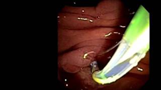 Enterohepatic Circulation of Bile Acids [upl. by Lawrenson]