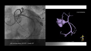 Angiogram  BRAIN angio procedure video [upl. by Maher]