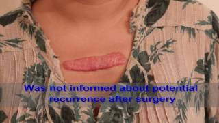 Chest Keloids  Mistakes to Avoid [upl. by Lois]