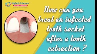 How can you treat an infected tooth socket after a tooth extraction  by Dr Vadivel Carrollton TX [upl. by Gentille]