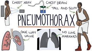 Pneumothorax [upl. by Acimat633]