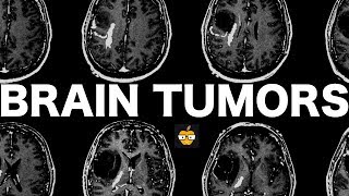 Brain Tumors [upl. by Keever530]