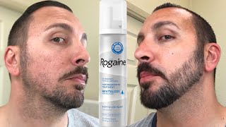 How to grow a REAL Beard  Minoxidil 4 Month Beard Journey [upl. by Ahsinid]