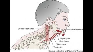 A common cause of TMD Suprahyoid muscle clenching [upl. by Herbie336]