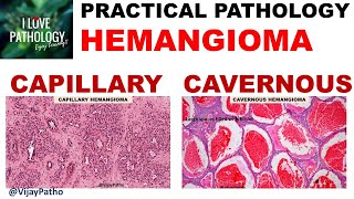 HEMANGIOMA capillary amp Cavernous Clinical features amp Morphology [upl. by Peonir893]