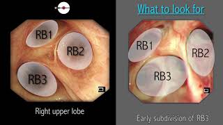 Mastering Bronchoscopy for Thoracic Surgery Chapter 2 [upl. by Omland931]