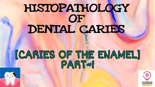 HISTOPATHOLOGY OF DENTAL CARIES  CARIES IN THE ENAMEL PART1 [upl. by Llehsram]