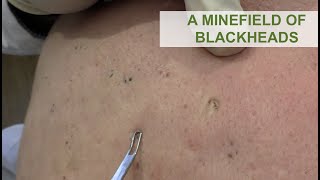 A Minefield of Blackheads  Dr Derm [upl. by Bowers]